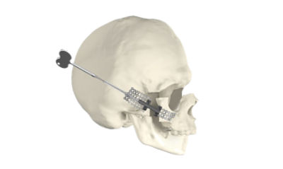 Advanced Midface Distractor | Stryker